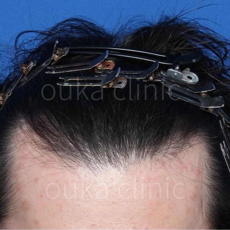 頭頂部、M字の治療後の画像